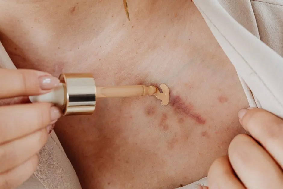 Applying concealer with a dropper to cover scars on skin in a close-up view.